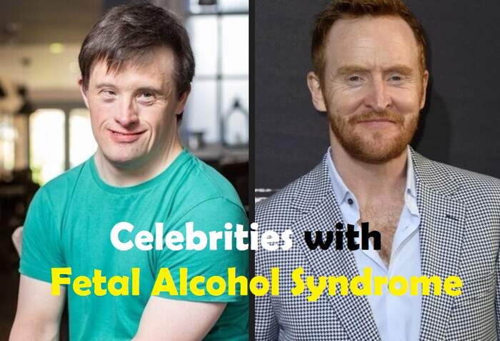 Celebrities with Fetal Alcohol Syndrome